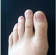 Foto 2. Piede di Morton Foto2