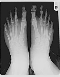Foto 3. Radiografia di tipico piede di Morton Foto3